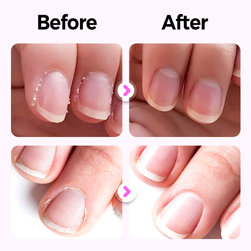 🔥Heißer Verkäufer 50% Rabatt🔥✨Kaufe 1 und erhalte 1 gratis 💜2025 Neuer und verbesserter 3-in-1-Nagelpflegestift.