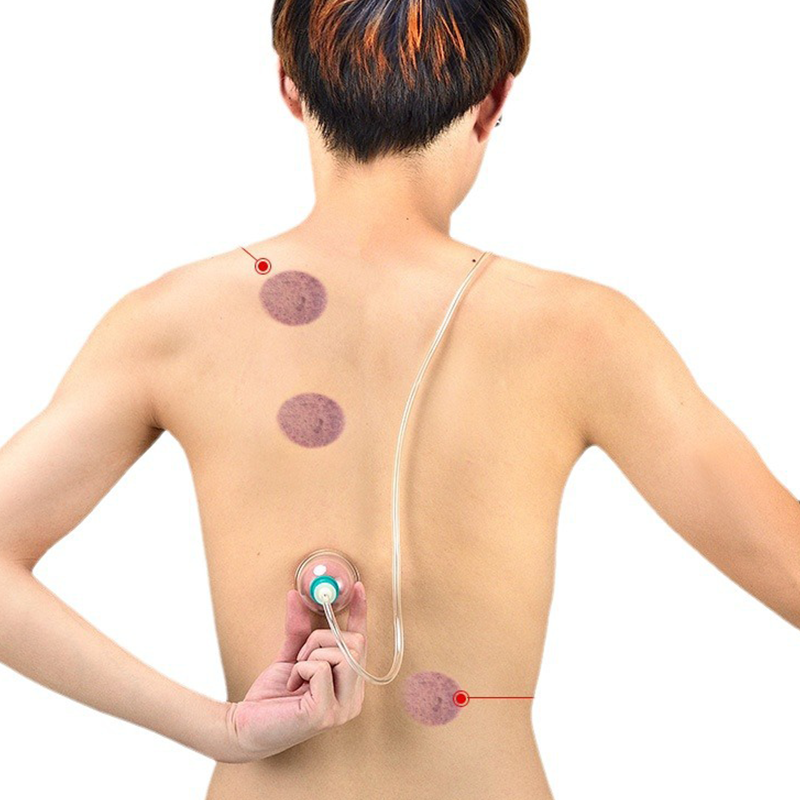 📢📢50 % Rabatt!! ⏰Vakuum-Schröpftherapie-Set – Verdickt, mit Saugpumpe, transparent 🩺